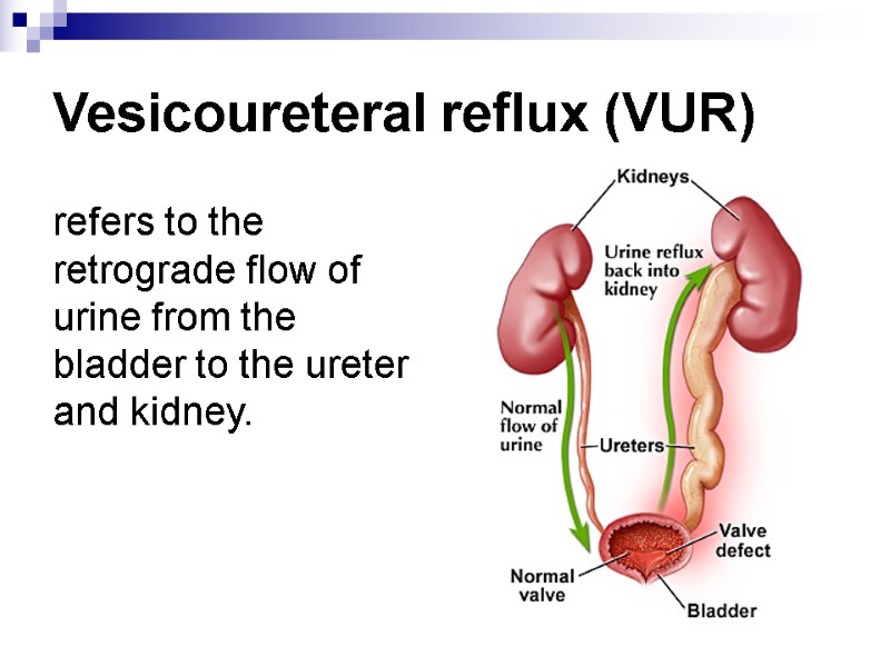 Vesicoureteral reflux (VUR) refers to the retrograde flow of urine from the bladder to